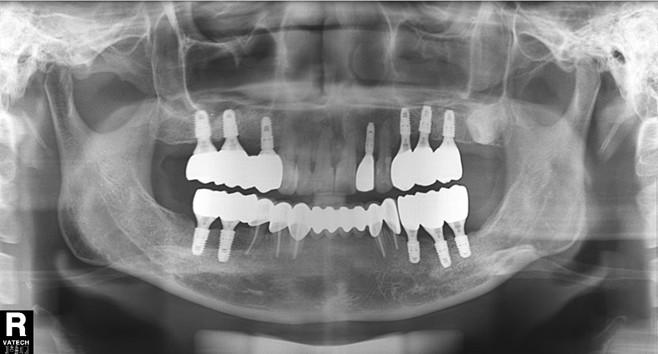 임플란트 후 X-ray